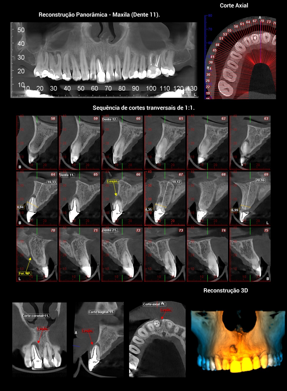 Tomografia para Endodontia
